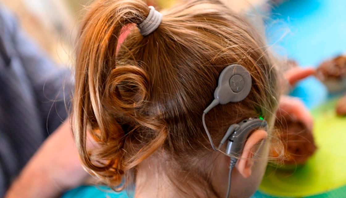 Cochlear Implants: How They Work and Who Can Benefit
